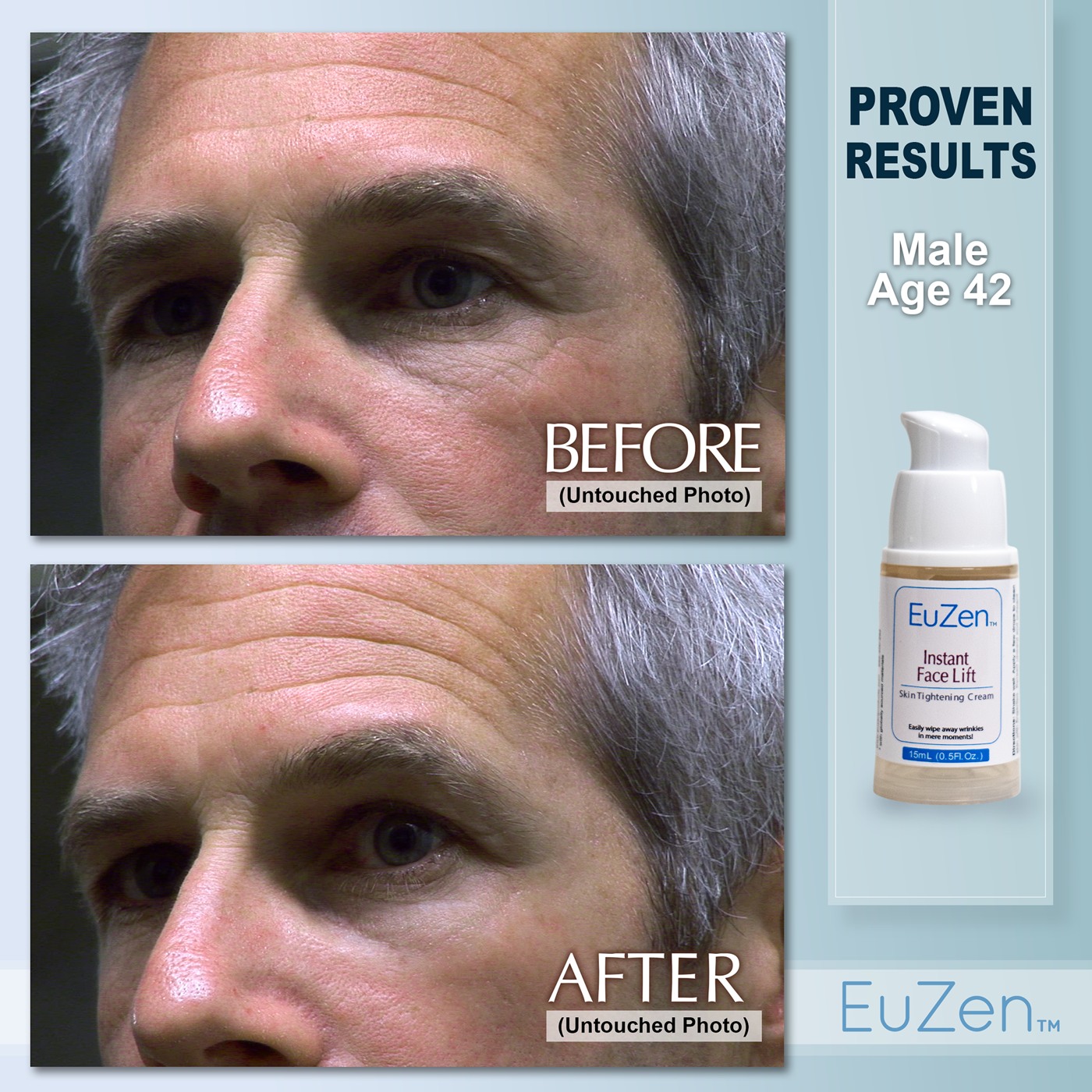 Man, age 42 before and after EuZen application