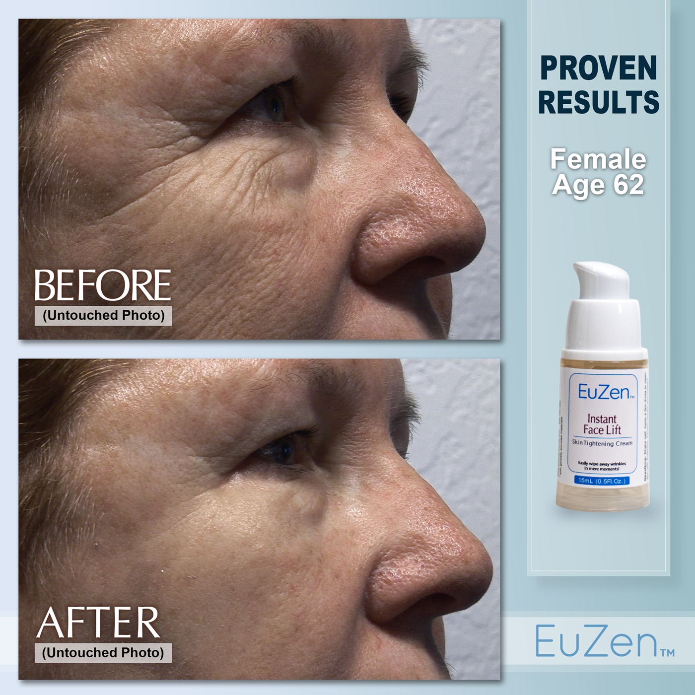 Woman, age 62 before and after EuZen application