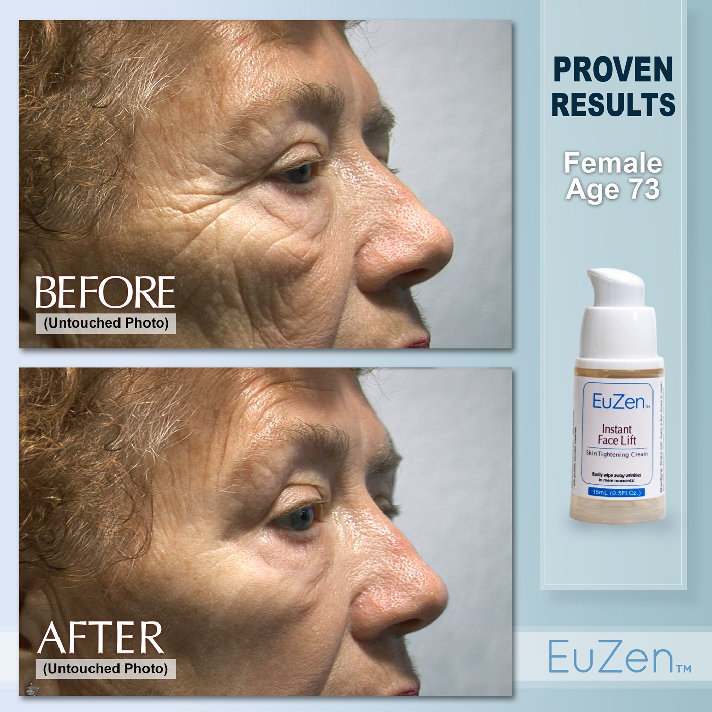 Woman, age 73 before and after EuZen application